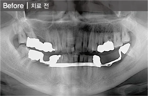 틀니를 임플란트로 교체한 증례(하악-04개(하악덴쳐를 임플란트로) 치료 전